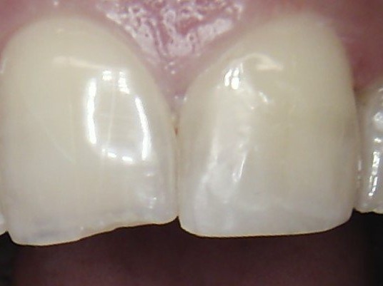 After: chipped tooth repair