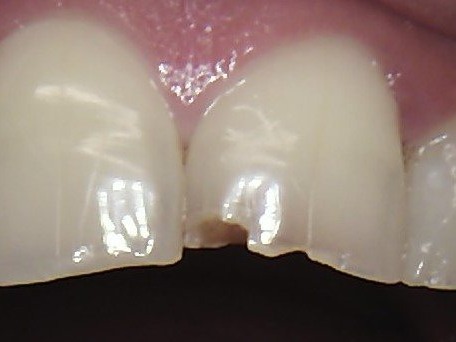 Before: chipped tooth repair