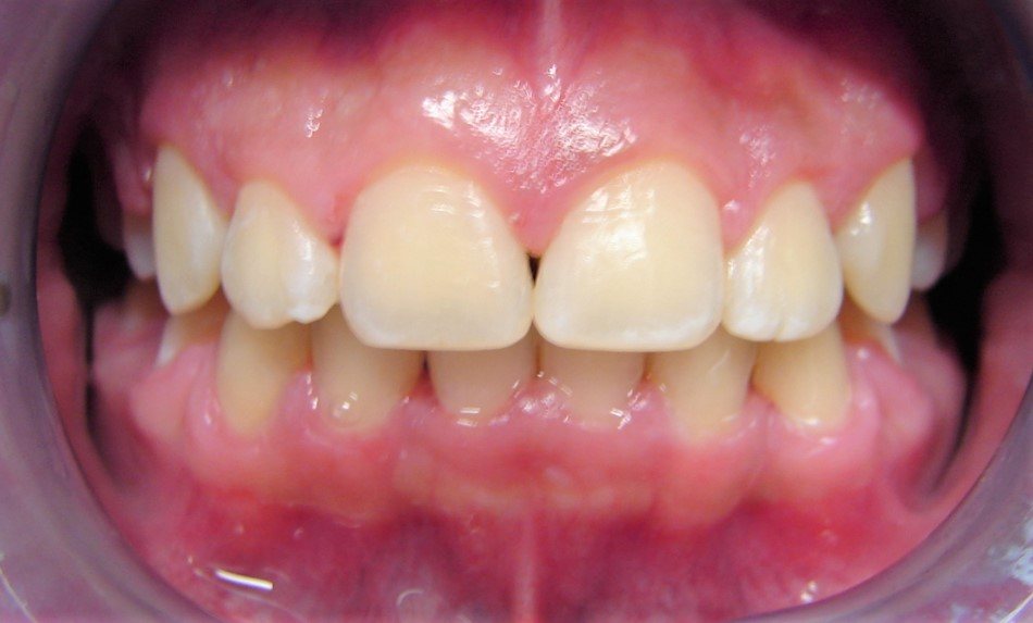 After: orthodontic treatment