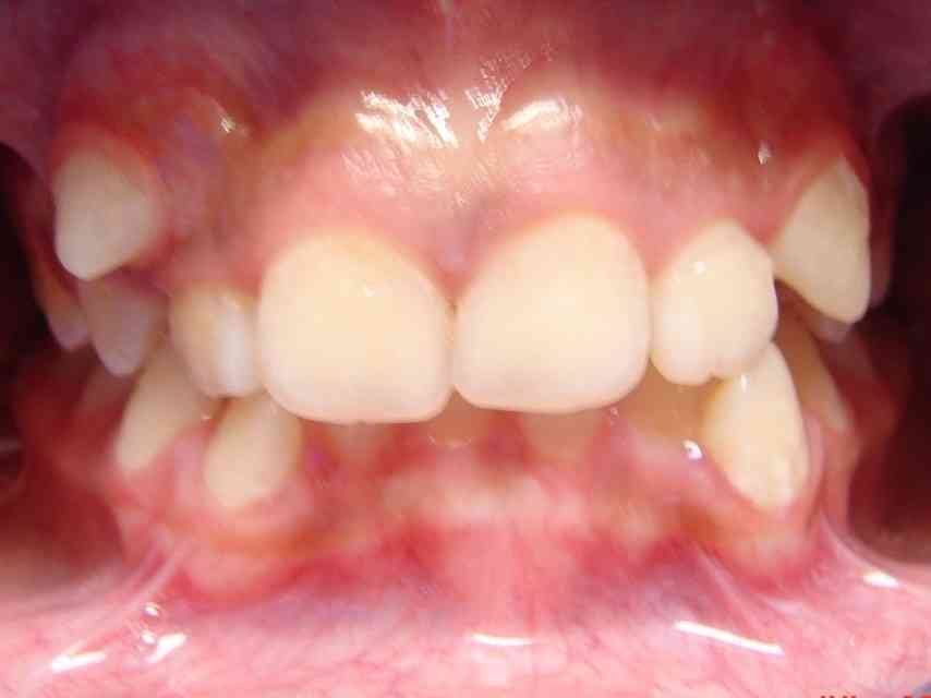 Before: orthodontic treatment