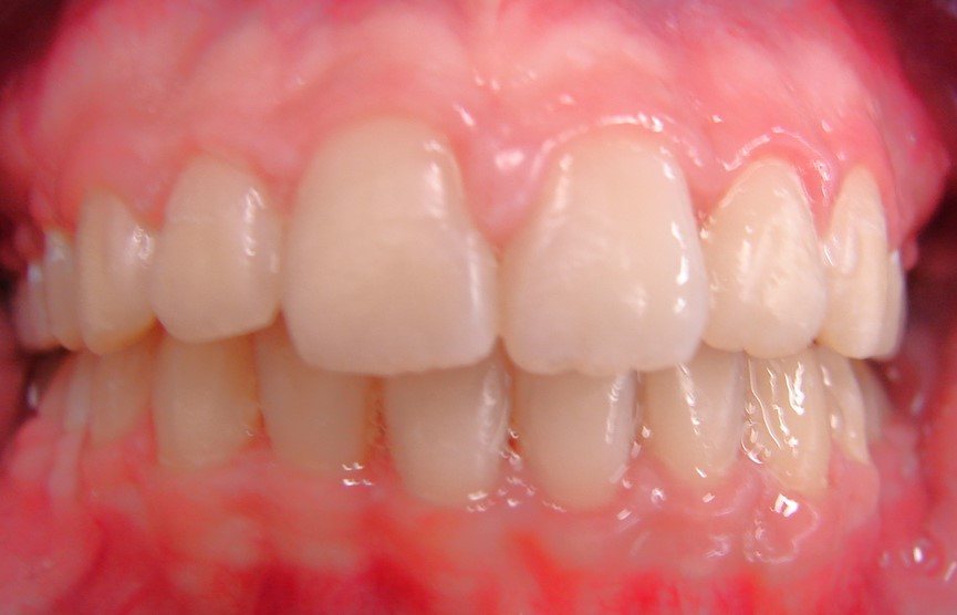 After: smile realignment