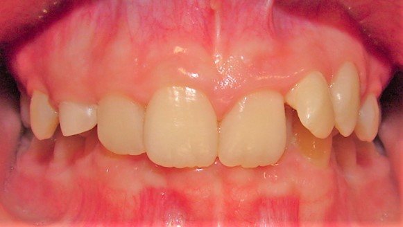Before: smile realignment