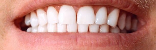 After: teeth whitening