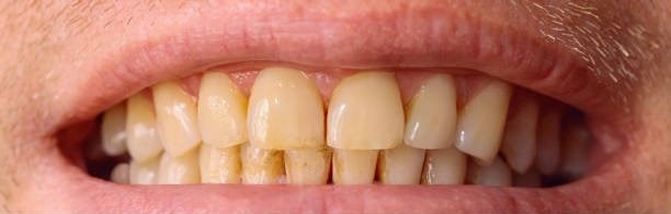 Before: teeth whitening